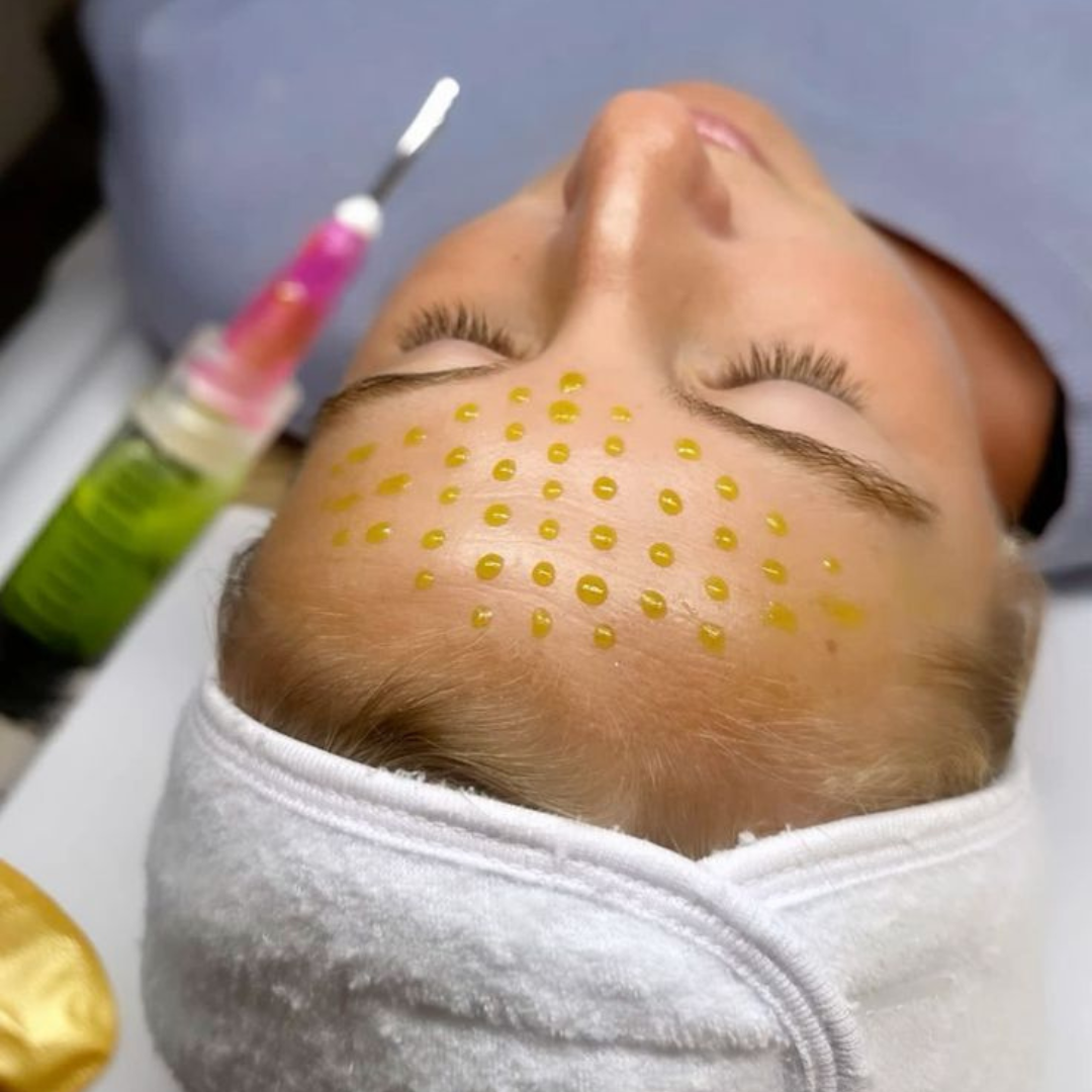 BioRePeel: The Ultimate Skin Rejuvenation Treatment for 2025