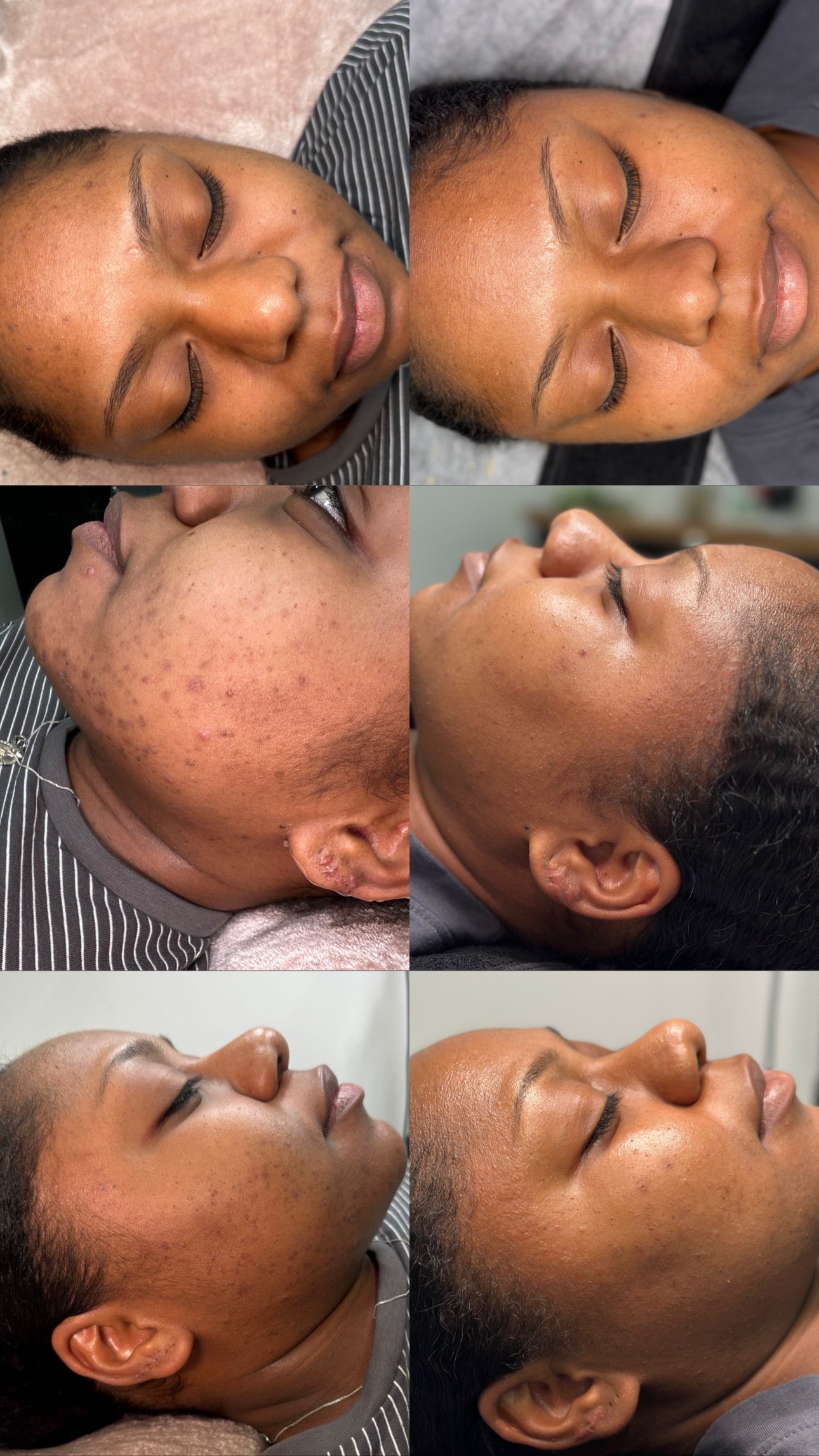 SQT Bio Micro Needling