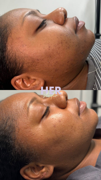 SQT Bio Micro Needling