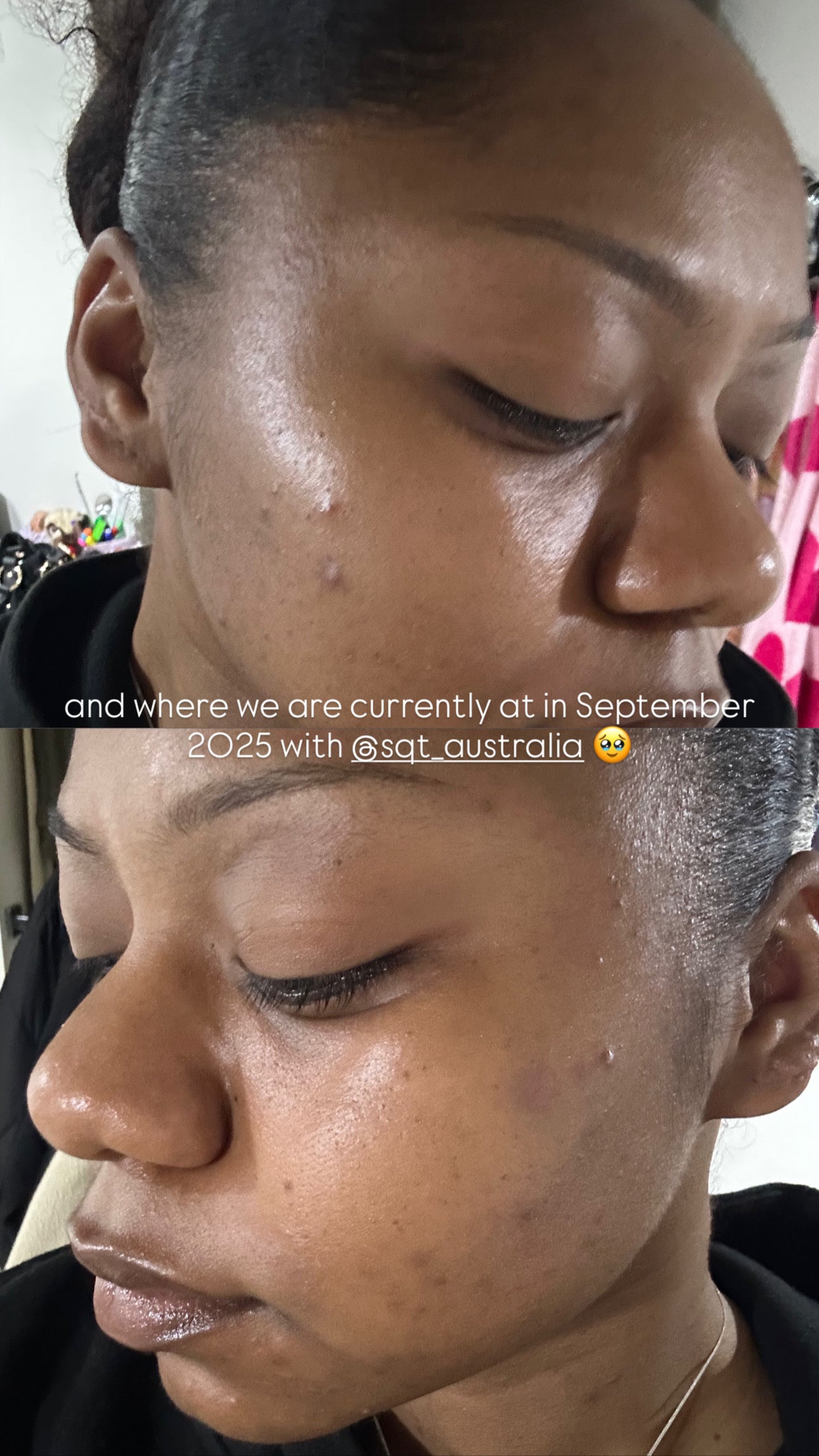SQT Bio Micro Needling