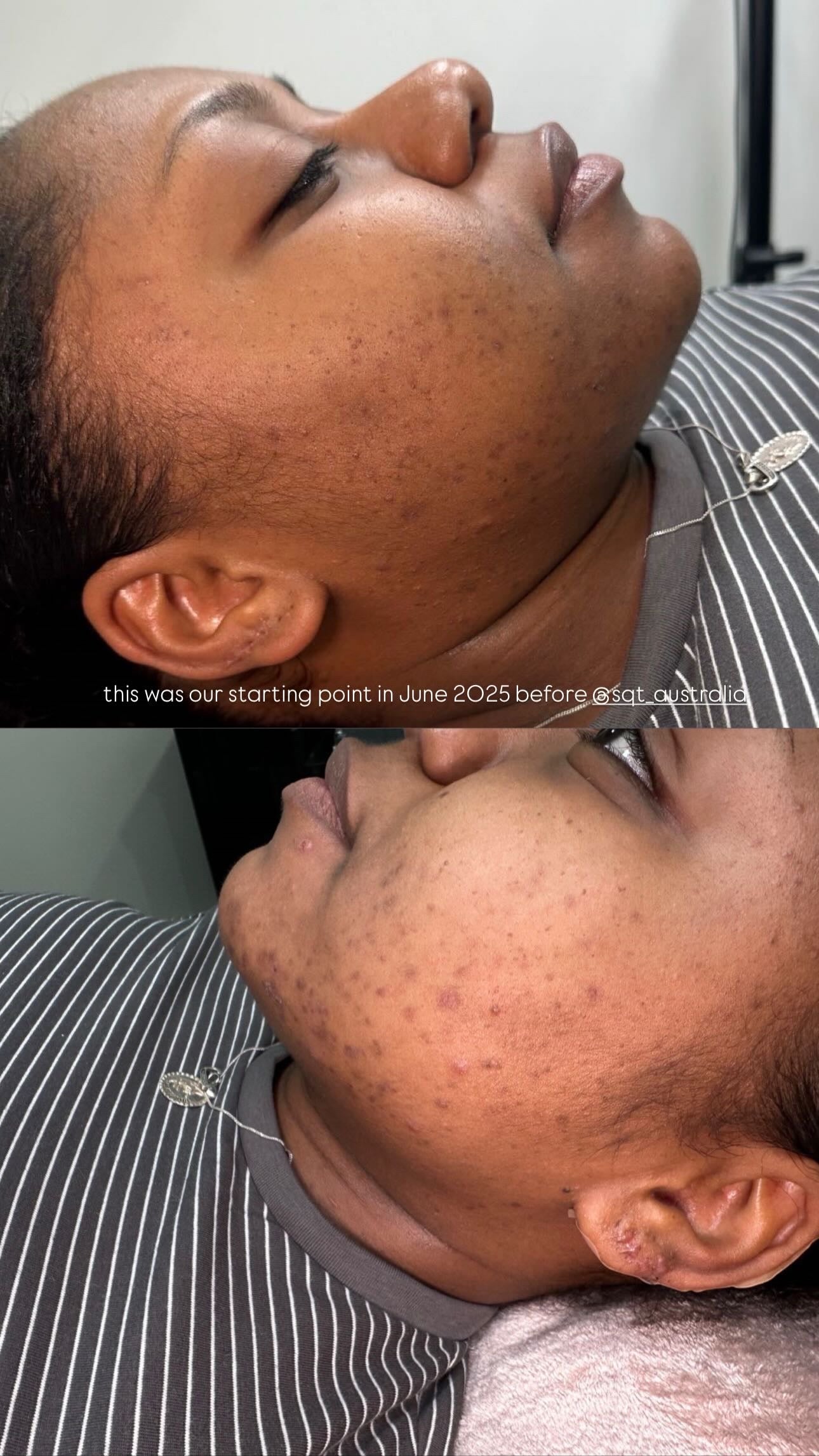 SQT Bio Micro Needling