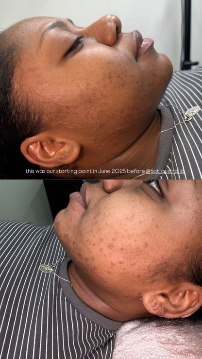 SQT Bio Micro Needling