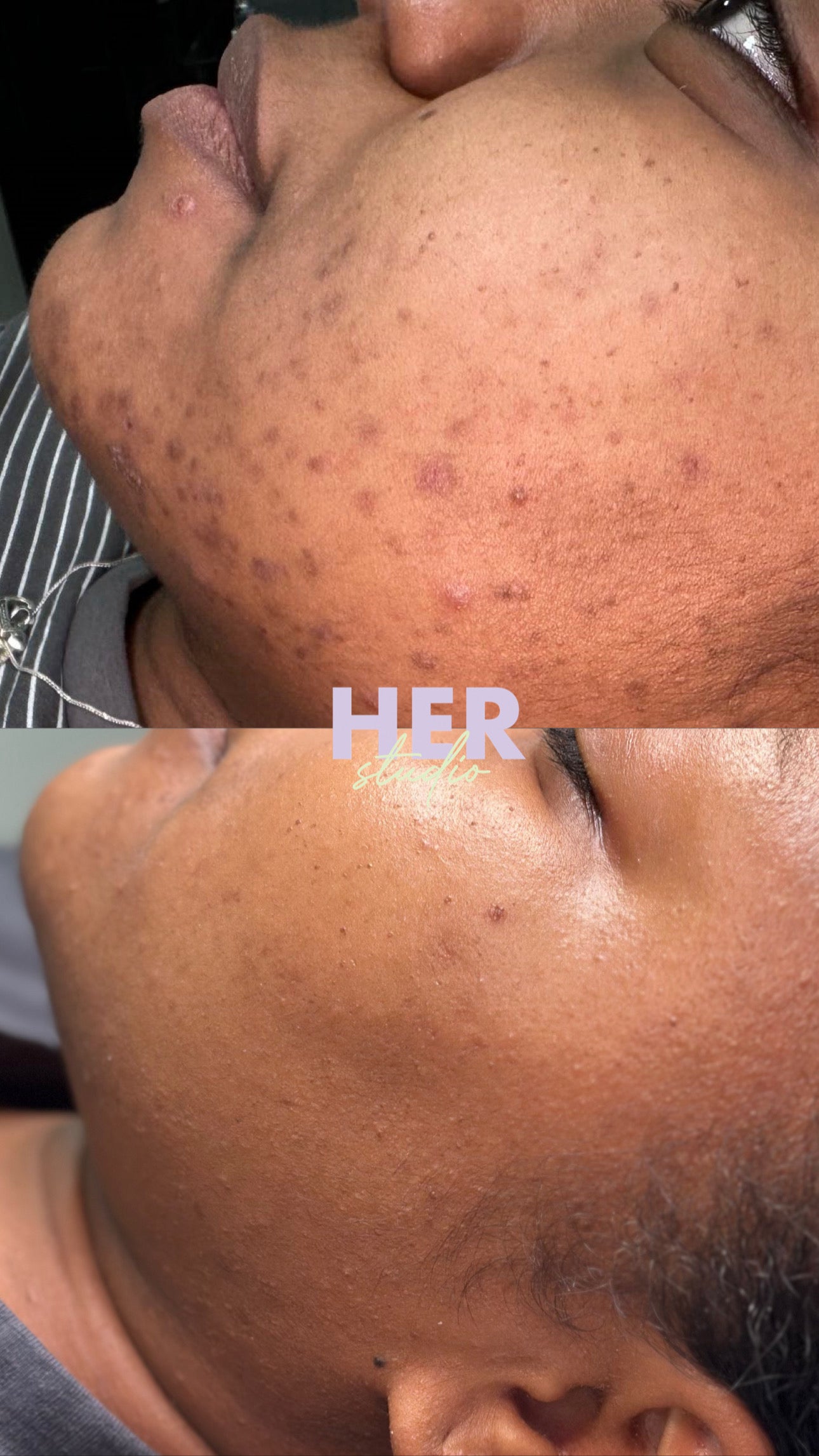 SQT Bio Micro Needling