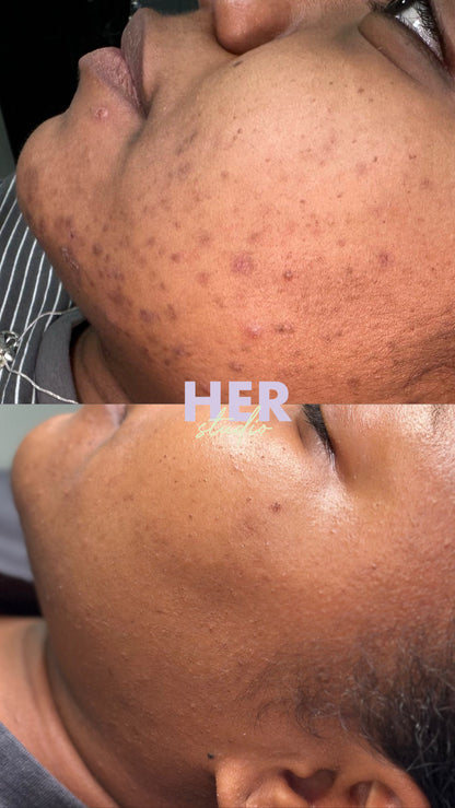 SQT Bio Micro Needling